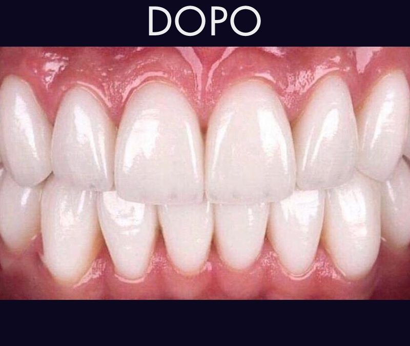 Le faccette dentali in ceramica regalano un sorriso libero da imperfezioni